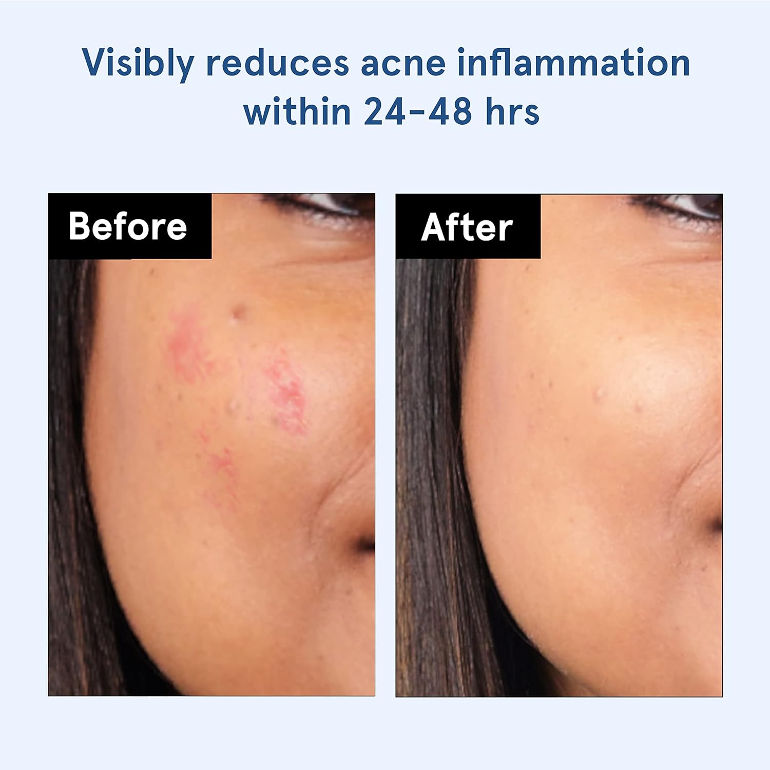 BeBodywise Hydrocolloid Acne Pimple Patch -24 pcs image 5