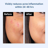 BeBodywise Hydrocolloid Acne Pimple Patch -24 pcs image 5